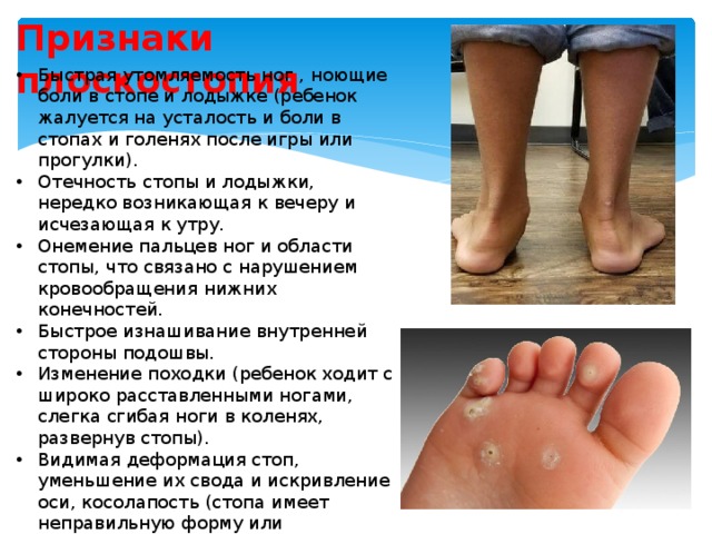 Признаки плоскостопия Быстрая утомляемость ног , ноющие боли в стопе и лодыжке (ребенок жалуется на усталость и боли в стопах и голенях после игры или прогулки). Отечность стопы и лодыжки, нередко возникающая к вечеру и исчезающая к утру. Онемение пальцев ног и области стопы, что связано с нарушением кровообращения нижних конечностей. Быстрое изнашивание внутренней стороны подошвы. Изменение походки (ребенок ходит с широко расставленными ногами, слегка сгибая ноги в коленях, развернув стопы). Видимая деформация стоп, уменьшение их свода и искривление оси, косолапость (стопа имеет неправильную форму или становится шире). Врастание ногтей пальцев ног в кожу. Искривление пальцев ног. Частое появление мозолей. 