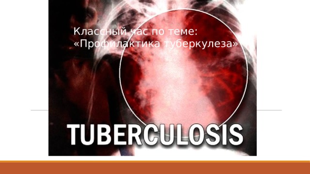 Классный час по теме: «Профилактика туберкулеза» 