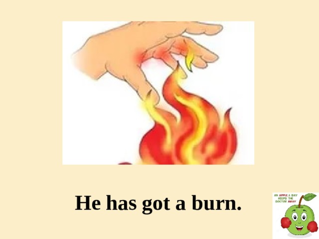 He has got a burn.
