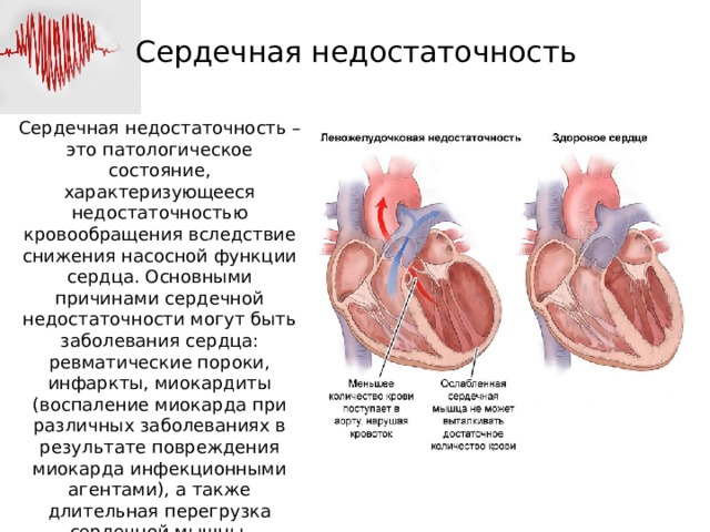 Заболевание сердца сопровождающееся сердечной недостаточностью. Причины возникновения сердечной недостаточности. Сердечная недостаточность причины. Сердечно недостаточность причины. Сердечная недостаточность причины возникновения.