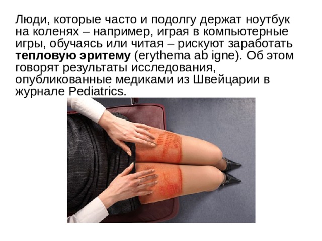  Люди, которые часто и подолгу держат ноутбук на коленях – например, играя в компьютерные игры, обучаясь или читая – рискуют заработать тепловую эритему (erythema ab igne). Об этом говорят результаты исследования, опубликованные медиками из Швейцарии в журнале Pediatrics. 