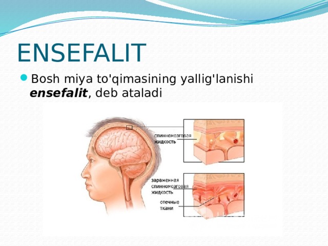 ENSEFALIT Bosh miya to'qimasining yallig'lanishi ensefalit , deb ataladi 