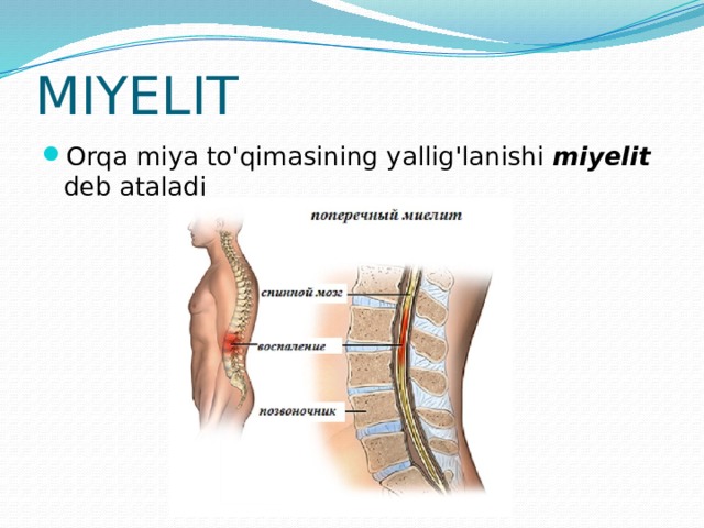 MIYELIT Orqa miya to'qimasining yallig'lanishi miyelit deb ataladi 