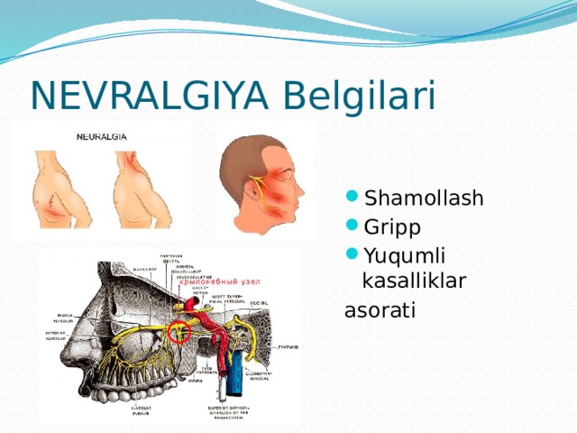 NEVRALGIYA Belgilari Shamollash Gripp Yuqumli kasalliklar asorati 