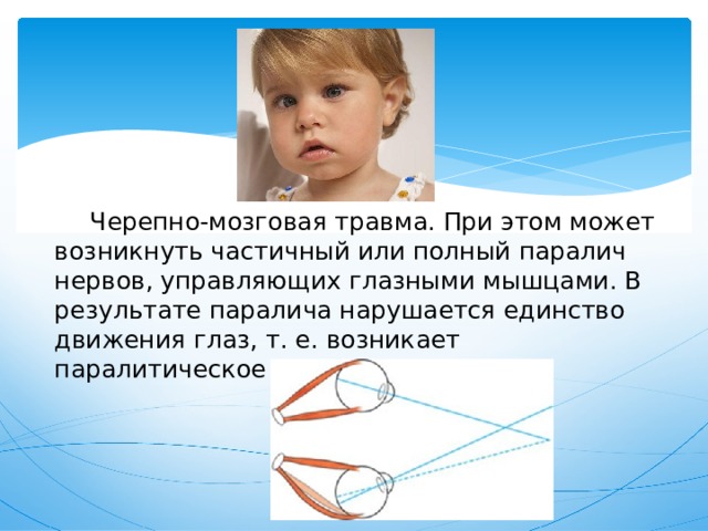  Черепно-мозговая травма. При этом может возникнуть частичный или полный паралич нервов, управляющих глазными мышцами. В результате паралича нарушается единство движения глаз, т. е. возникает паралитическое косоглазие. 