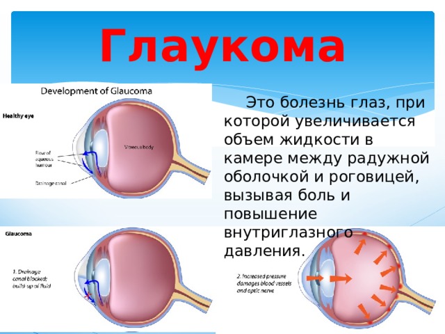 Глаукома  Это болезнь глаз, при которой увеличивается объем жидкости в камере между радужной оболочкой и роговицей, вызывая боль и повышение внутриглазного давления. 