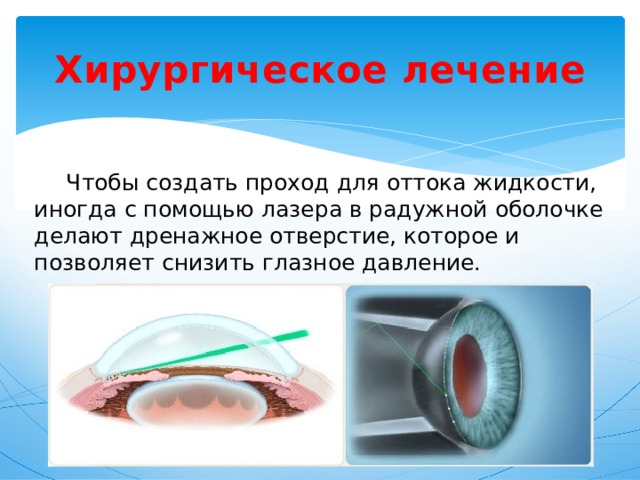 Хирургическое лечение  Чтобы создать проход для оттока жидкости, иногда с помощью лазера в радужной оболочке делают дренажное отверстие, которое и позволяет снизить глазное давление. 