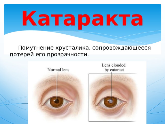 Катаракта  Помутнение хрусталика, сопровождающееся потерей его прозрачности. 