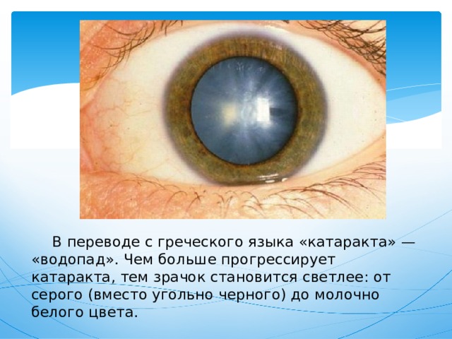  В переводе с греческого языка «катаракта» — «водопад». Чем больше прогрессирует катаракта, тем зрачок становится светлее: от серого (вместо угольно черного) до молочно белого цвета. 