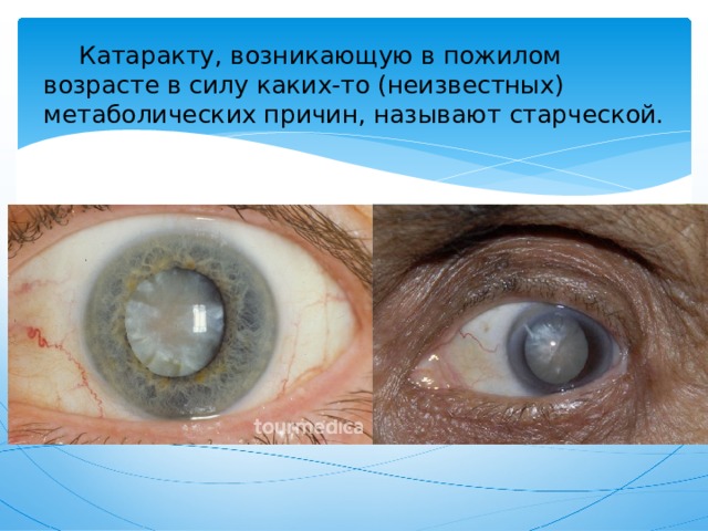  Катаракту, возникающую в пожилом возрасте в силу каких-то (неизвестных) метаболических причин, называют старческой. 