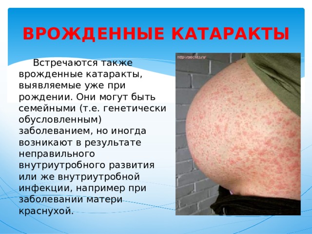ВРОЖДЕННЫЕ КАТАРАКТЫ  Встречаются также врожденные катаракты, выявляемые уже при рождении. Они могут быть семейными (т.е. генетически обусловленным) заболеванием, но иногда возникают в результате неправильного внутриутробного развития или же внутриутробной инфекции, например при заболевании матери краснухой. 