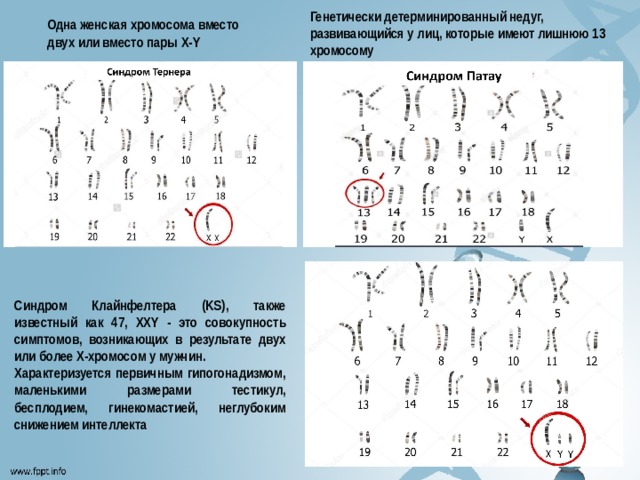 Генетически детерминированный недуг, развивающийся у лиц, которые имеют лишнюю 13 хромосому Одна женская хромосома вместо двух или вместо пары Х-Y Синдром Клайнфелтера (KS), также известный как 47, XXY - это совокупность симптомов, возникающих в результате двух или более Х-хромосом у мужчин. Характеризуется первичным гипогонадизмом, маленькими размерами тестикул, бесплодием, гинекомастией, неглубоким снижением интеллекта 