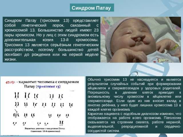 Патау синдром клиническая картина