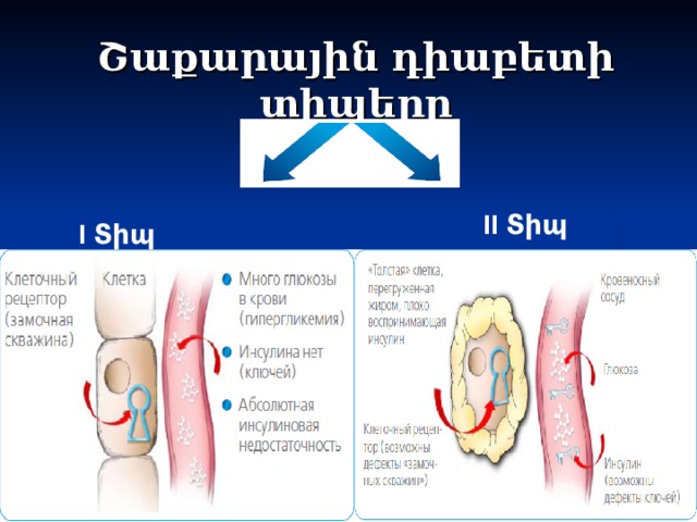 Շաքարային դիաբետի տիպերը II Տիպ I Տիպ Notes pages at the bottom  