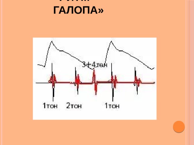 Схема ритма галопа