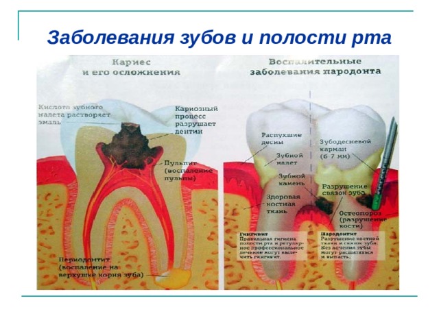 Заболевания зубов и полости рта 