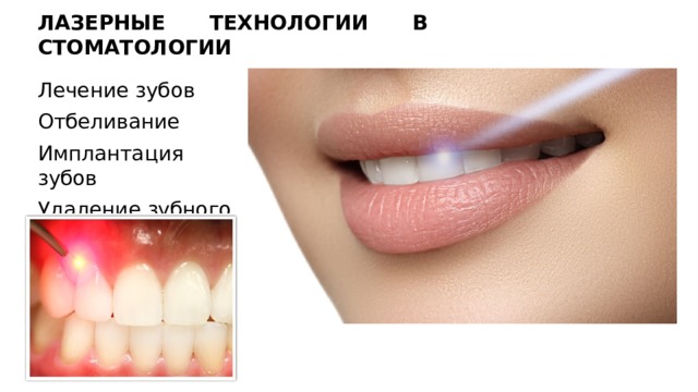 ЛАЗЕРНЫЕ ТЕХНОЛОГИИ В СТОМАТОЛОГИИ Лечение зубов Отбеливание Имплантация зубов Удаление зубного камня 
