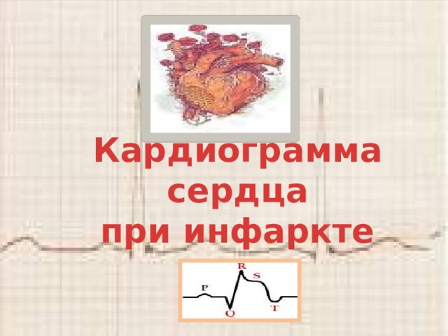 Кардиограмма сердца при инфаркте 