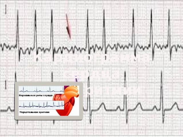 Кардиограмма сердца при аритмии 