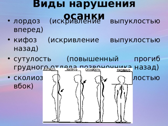 Какой вид нарушений. Нарушение осанки лордоз. Типы искривления осанки. Нарушение осанки лордоз кифоз сколиоз. Типы нарушения осанки лордоз.