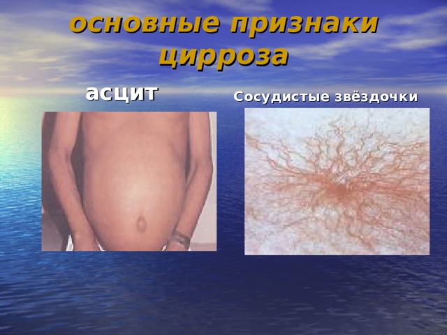  основные признаки цирроза   асцит Сосудистые звёздочки 