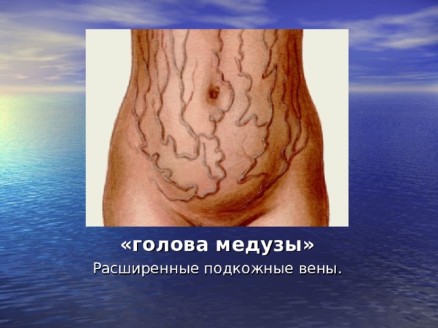 «голова медузы» Расширенные подкожные вены. 