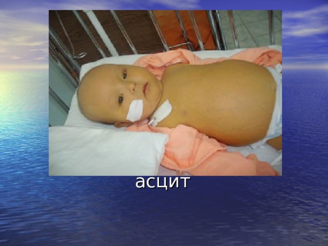   асцит 