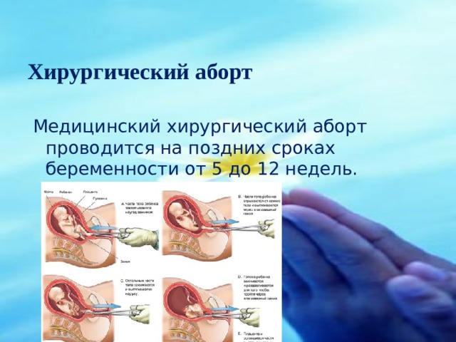 Хирургический аборт   Медицинский хирургический аборт проводится на поздних сроках беременности от 5 до 12 недель. 