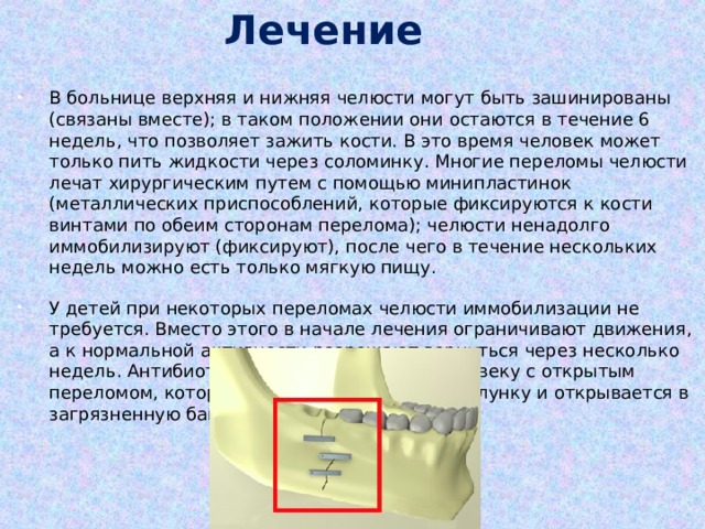 Лечение В больнице верхняя и нижняя челюсти могут быть зашинированы (связаны вместе); в таком положении они остаются в течение 6 недель, что позволяет зажить кости. В это время человек может только пить жидкости через соломинку. Многие переломы челюсти лечат хирургическим путем с помощью минипластинок (металлических приспособлений, которые фиксируются к кости винтами по обеим сторонам перелома); челюсти ненадолго иммобилизируют (фиксируют), после чего в течение нескольких недель можно есть только мягкую пищу. У детей при некоторых переломах челюсти иммобилизации не требуется. Вместо этого в начале лечения ограничивают движения, а к нормальной активности разрешают вернуться через несколько недель. Антибиотики обычно назначают человеку с открытым переломом, который проходит через зуб или лунку и открывается в загрязненную бактериями полость рта. 