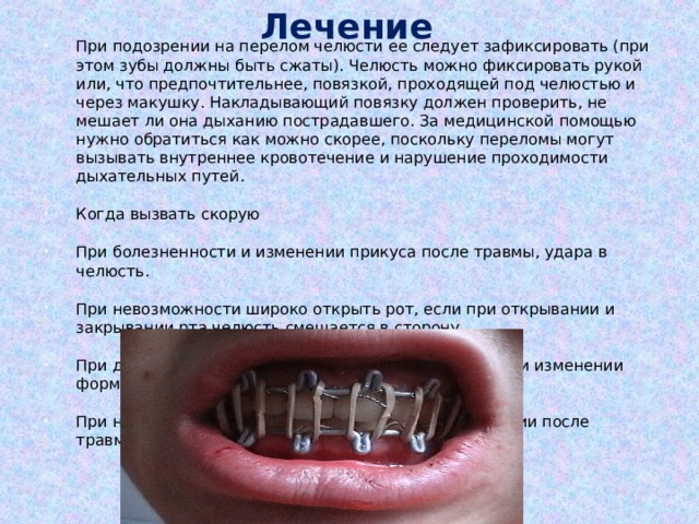 Лечение При подозрении на перелом челюсти ее следует зафиксировать (при этом зубы должны быть сжаты). Челюсть можно фиксировать рукой или, что предпочтительнее, повязкой, проходящей под челюстью и через макушку. Накладывающий повязку должен проверить, не мешает ли она дыханию пострадавшего. За медицинской помощью нужно обратиться как можно скорее, поскольку переломы могут вызывать внутреннее кровотечение и нарушение проходимости дыхательных путей. Когда вызвать скорую При болезненности и изменении прикуса после травмы, удара в челюсть. При невозможности широко открыть рот, если при открывании и закрывании рта челюсть смещается в сторону. При двоении в глазах, онемении кожи под глазом, при изменении формы скуловой дуги. При нарушении речи жевания, обильном слюнотечении после травмы. 