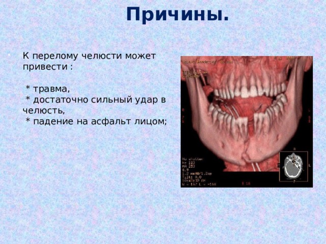 Причины. К перелому челюсти может привести :   * травма,  * достаточно сильный удар в челюсть,  * падение на асфальт лицом; 