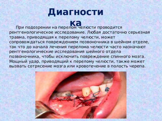 Диагностика  При подозрении на перелом челюсти проводится рентгенологическое исследование. Любая достаточно серьезная травма, приводящая к перелому челюсти, может сопровождаться повреждением позвоночника в шейном отделе, так что до начала лечения перелома челюсти часто назначают рентгенологические исследования шейного отдела позвоночника, чтобы исключить повреждение спинного мозга. Мощный удар, приводящий к перелому челюсти, также может вызвать сотрясение мозга или кровотечение в полость черепа. 