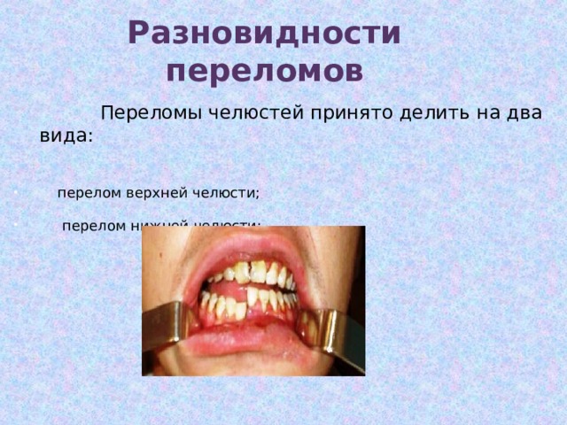 Разновидности переломов    Переломы челюстей принято делить на два вида:    перелом верхней челюсти;  перелом нижней челюсти; 