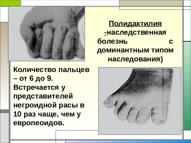 Полидактилия - наследственная болезнь с доминантным типом наследования) Количество пальцев – от 6 до 9. Встречается у представителей негроидной расы в 10 раз чаще, чем у европеоидов. 