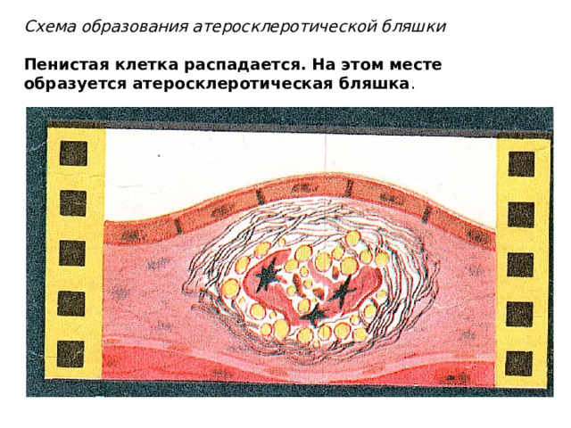 Схема образования атеросклеротической бляшки   Пенистая клетка распадается. На этом месте образуется атеросклеротическая бляшка . 