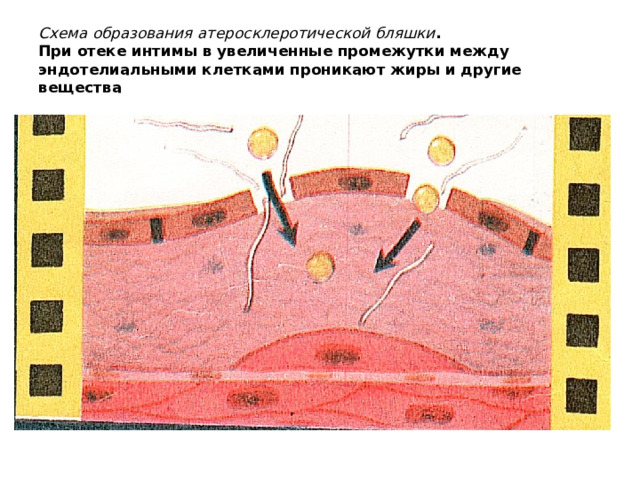 Схема образования атеросклеротической бляшки .  При отеке интимы в увеличенные промежутки между эндотелиальными клетками проникают жиры и другие вещества 