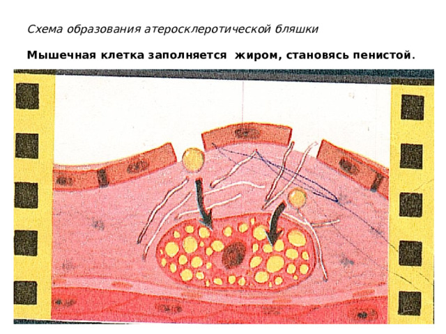 Схема образования атеросклеротической бляшки   Мышечная клетка заполняется жиром, становясь пенистой . 