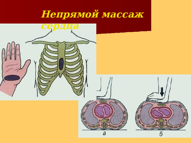 Непрямой массаж  сердца 