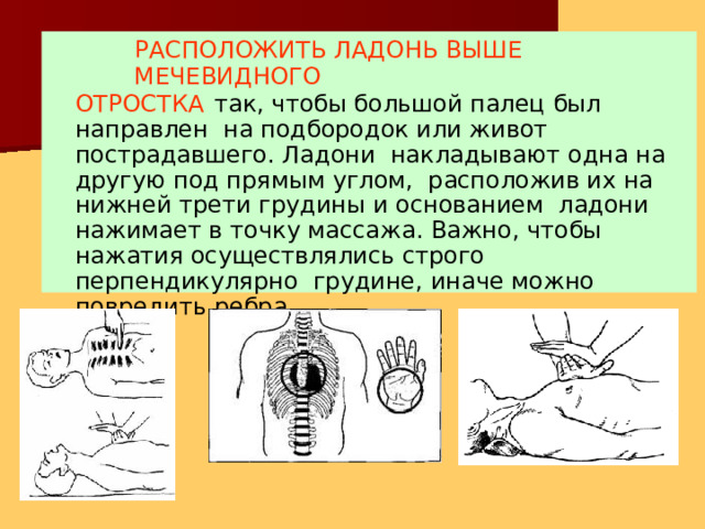 РАСПОЛОЖИТЬ ЛАДОНЬ ВЫШЕ  МЕЧЕВИДНОГО ОТРОСТКА  так, чтобы большой палец был направлен на подбородок или живот пострадавшего. Ладони накладывают одна на другую под прямым углом, расположив их на нижней трети грудины и основанием ладони нажимает в точку массажа. Важно, чтобы нажатия осуществлялись строго перпендикулярно грудине, иначе можно повредить ребра. 