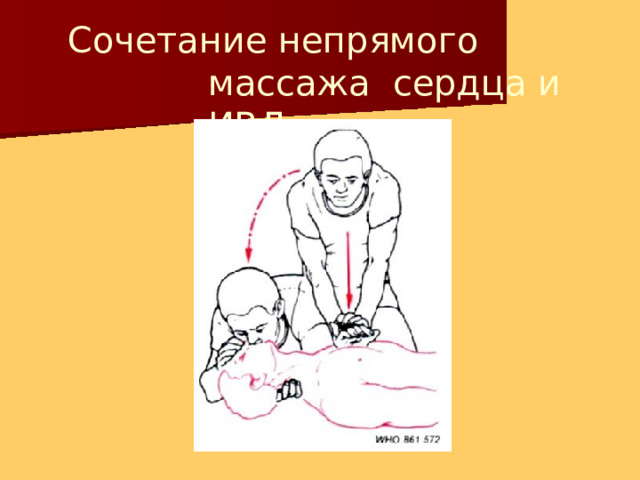 Сочетание непрямого массажа сердца и  ИВЛ 
