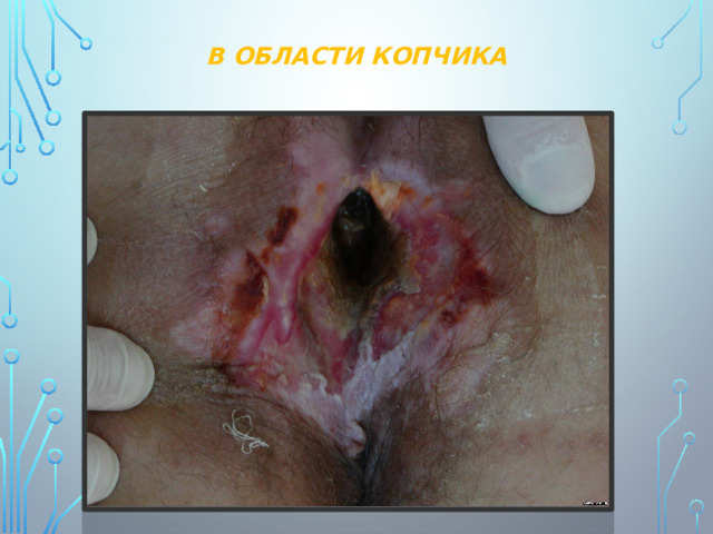 В ОБЛАСТИ КОПЧИКА 