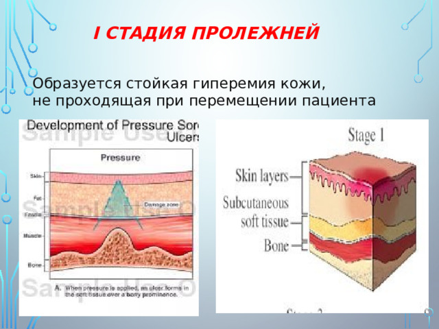 I СТАДИЯ ПРОЛЕЖНЕЙ Образуется стойкая гиперемия кожи, не проходящая при перемещении пациента 