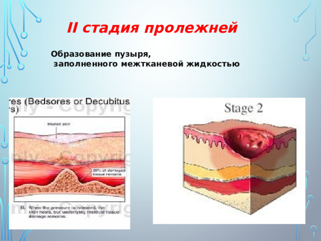 II стадия пролежней Образование пузыря,  заполненного межтканевой жидкостью 