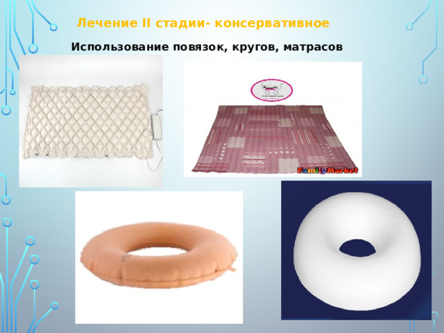 Лечение II стадии- консервативное Использование повязок, кругов, матрасов 