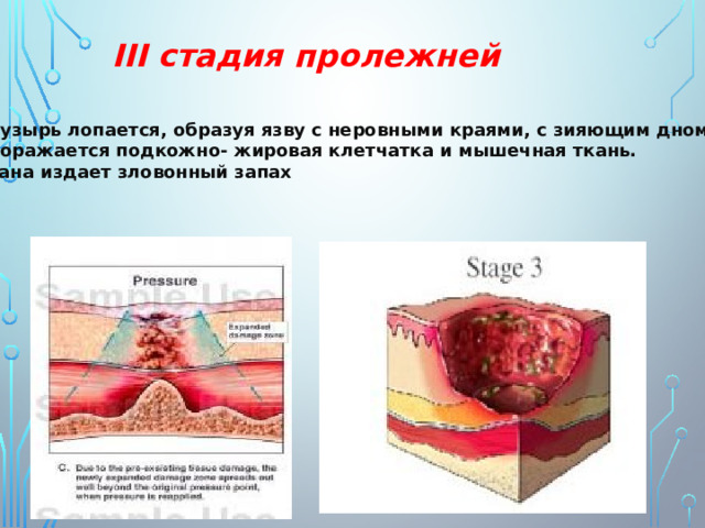 III стадия пролежней Пузырь лопается, образуя язву с неровными краями, с зияющим дном. Поражается подкожно- жировая клетчатка и мышечная ткань. Рана издает зловонный запах 