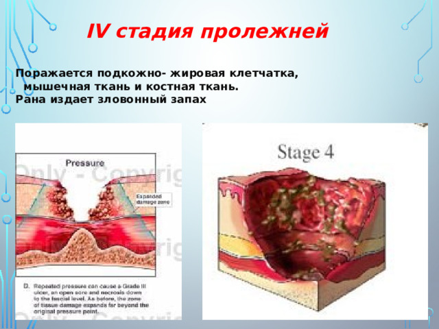 IV стадия пролежней  Поражается подкожно- жировая клетчатка,  мышечная ткань и костная ткань. Рана издает зловонный запах 