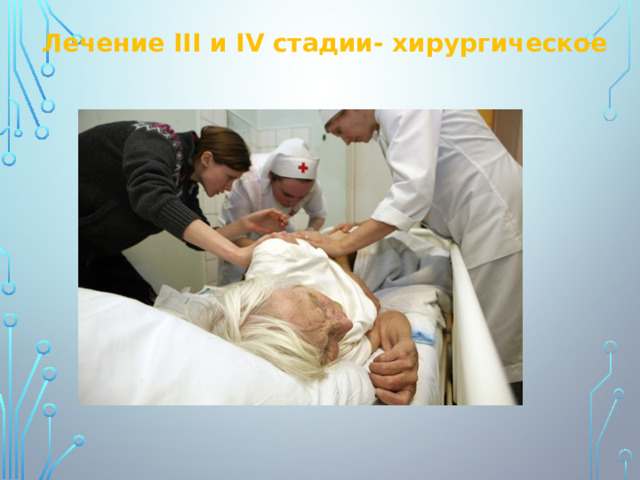 Лечение III и IV стадии- хирургическое 