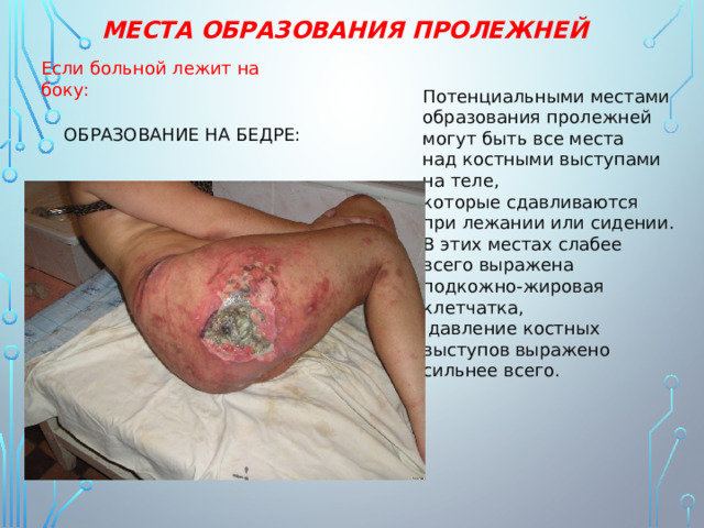 МЕСТА ОБРАЗОВАНИЯ ПРОЛЕЖНЕЙ Если больной лежит на боку: Потенциальными местами образования пролежней могут быть все места над костными выступами на теле, которые сдавливаются при лежании или сидении. В этих местах слабее всего выражена подкожно-жировая клетчатка,  давление костных выступов выражено сильнее всего. ОБРАЗОВАНИЕ НА БЕДРЕ: 