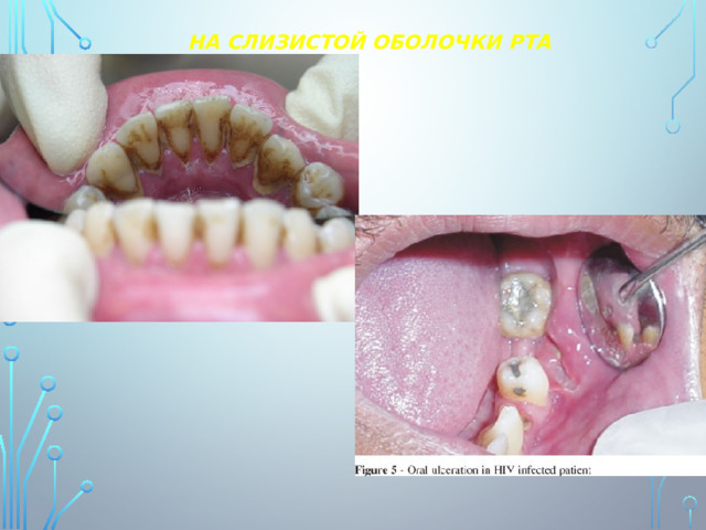 НА СЛИЗИСТОЙ ОБОЛОЧКИ РТА 