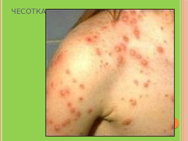 Чесотка 